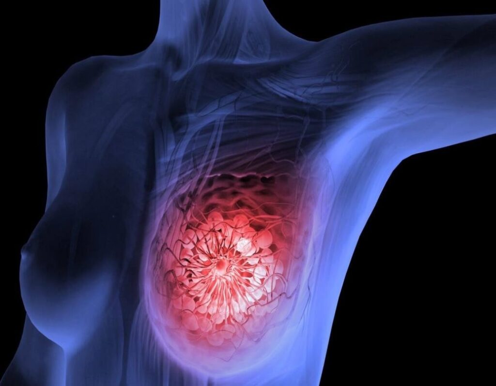 Breast cancer: Risk factors, symptoms, treatments